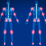 skeleton showing joint hot spots