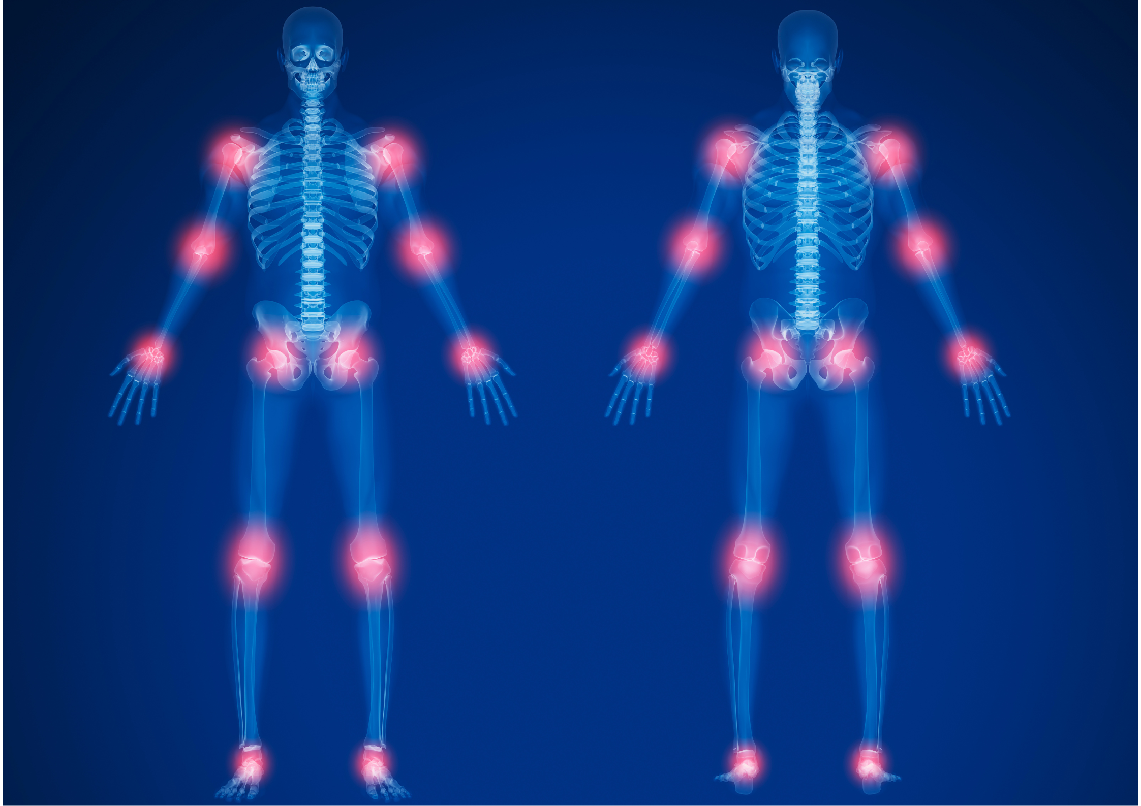 skeleton showing joint hot spots